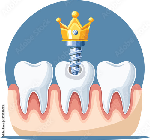 Dental crown being placed on prepared tooth, restorative dentistry step icon