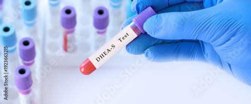 Obraz na płótnie Doctor holding DHEA S blood test tube explaining adrenal androgen hormone levels
