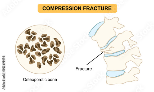 spinal compression fracture. Vertebral compression fracture, back pain, osteoporosis. Vector flat illustration for medical, clinical, or educational posters.