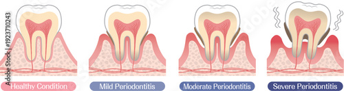 Progression of Periodontal Disease Stages Illustration