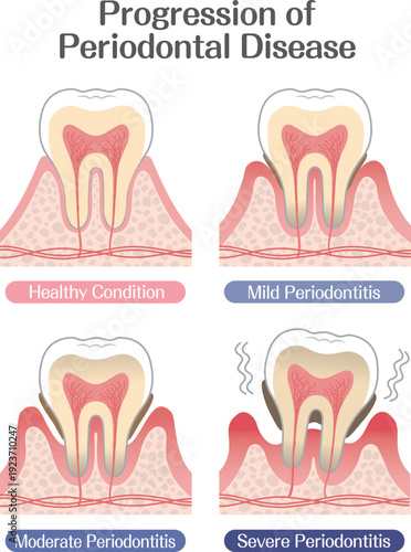 Progression of Periodontal Disease Stages Illustration