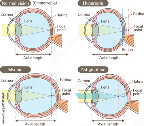 Structure of the Eye and Refractive Errors Diagram