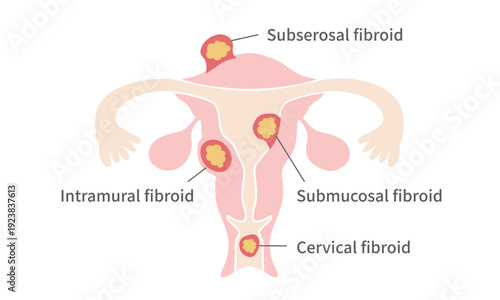 Types of Uterine Fibroids – Intramural, Submucosal, Subserosal, and Cervical Fibroids