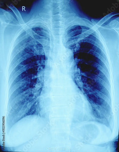 Foto X-ray of human chest. Suggestive of pneumonitis.