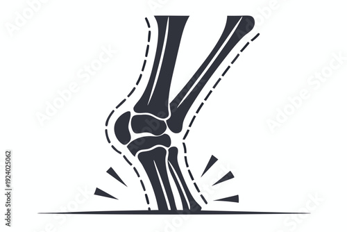 Twisted ankle silhouette shows bones displaced during injury indicating possible sprain or fracture