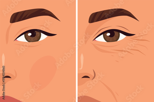 Wrinkles on the face, under the eyes. Vector illustration, young and aged facial skin. Smooth, taut skin and wrinkles, sagging, loss of volume. For anti-aging products, skin care, cosmetic surgery