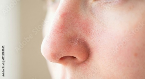 Red irritated skin on nose with peeling and dryness