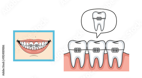 A detailed dental illustration showing teeth with metal braces for orthodontic treatment, including a close-up view and a smiling mouth.