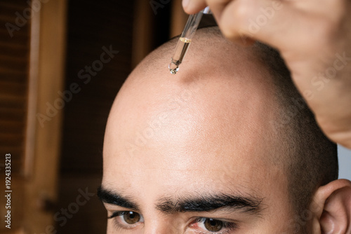 Applying Hair Serum on Bald Scalp for Hair Growth Treatment