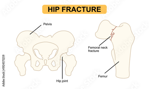 Medical Illustration of Femoral Neck Fracture in Human Hip Joint, fractured bone in the hip, osteoporosis bone. flat vector illustration for medical, poster and education.