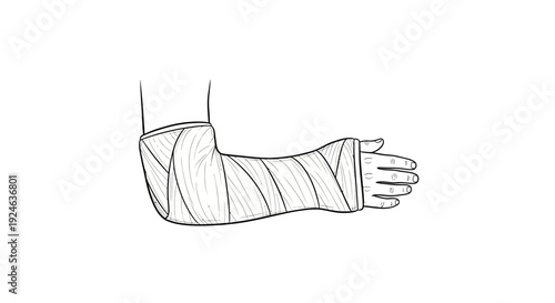 Arm Cast Illustration: Broken Bone Injury, Medical Treatment, Hand and Forearm Immobilization
