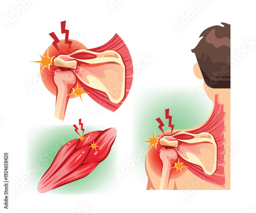 Scapula Muscle Inflammation and Shoulder Joint Pain Diagram