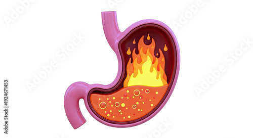 Illustration of a burning stomach representing heartburn or indigestion