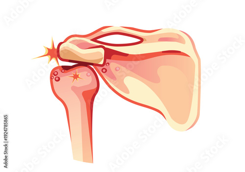 Scapula Bone Pain and Shoulder Inflammation