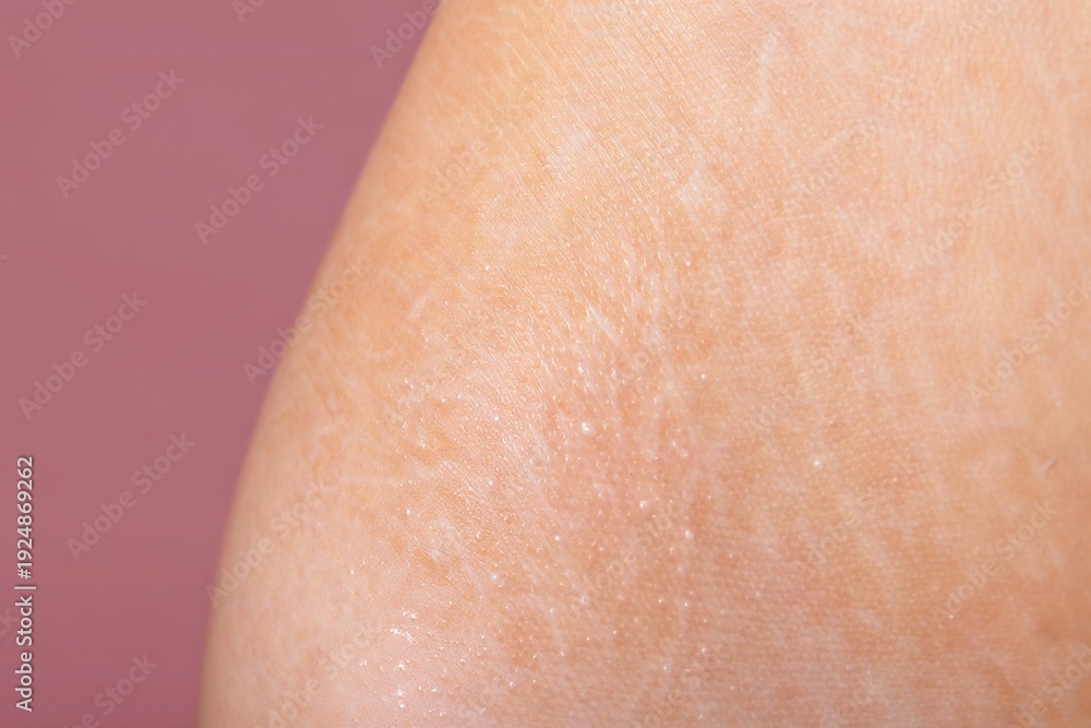 Fototapeta premium Closeup of skin detail highlighting natural stretch marks texture