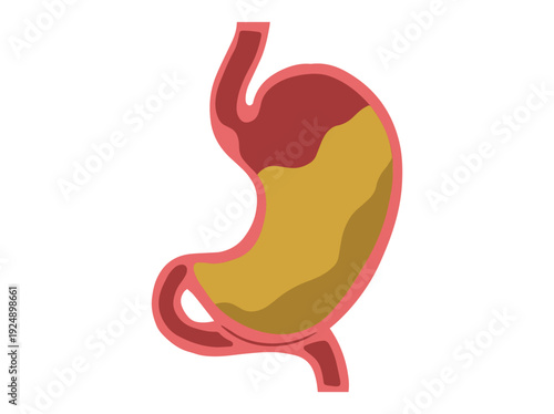 Gastroparesis Disease in Stomach Illustration
