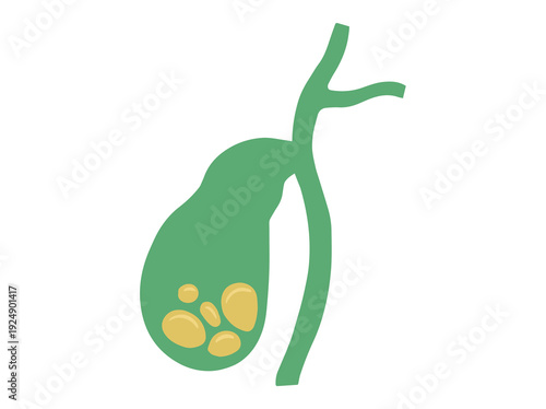 Gallbladder with Gallstones Clip Art