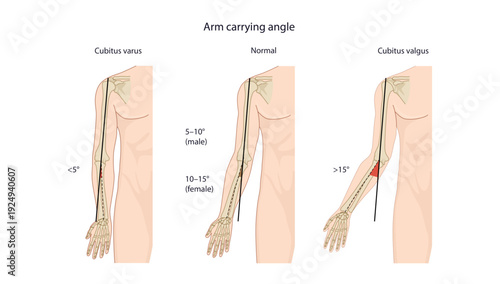 The angle between the arm and forearm when the elbow is fully extended and supinated; normally allows the forearm to clear the hips during walking.