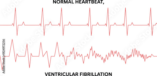 Detailed medical illustration comparing a healthy normal heartbeat rhythm with chaotic ventricular fibrillation displayed on an ECG graph