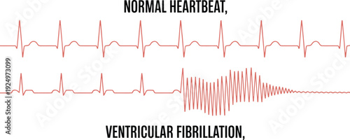 Dynamic medical representation displaying a normal heartbeat rhythm abruptly changing into chaotic ventricular fibrillation on an ECG