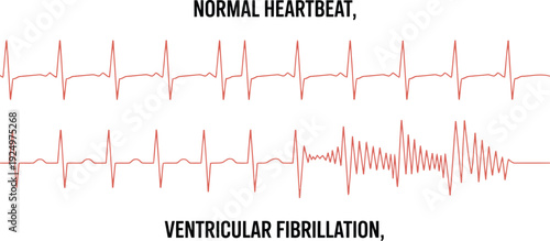 Medical visualization illustrating the clear distinction between a steady normal heartbeat and the onset of ventricular fibrillation on an ECG