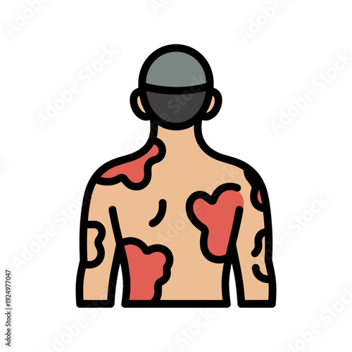 A vector graphic illustration of a man's back and arms showing red skin irritation or rash areas.