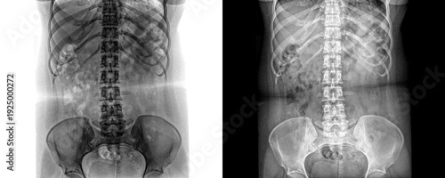 Fotografi High Resolution Lumbar Spine Anterior View X-ray Radiograph Depicting Detailed V