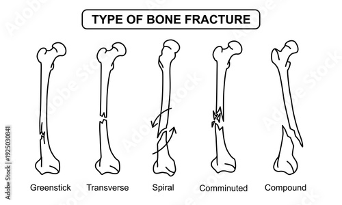 Medical Illustration of Type of Bone Fracture, greenstick, transverse, spiral, comminuted, compound, osteoporosis bone. vector drawing illustration for medical, poster and education.