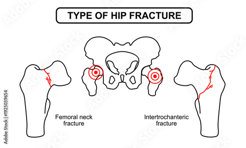Medical Illustration of Type of Hip Fracture, Human Joint, fractured bone in the hip, osteoporosis bone. Drawing vector illustration for medical, poster and education.