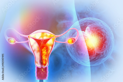 Uterus or uterine cancer. Medical concept as cancerous cells spreading in a female reproductive system. 3d illustration