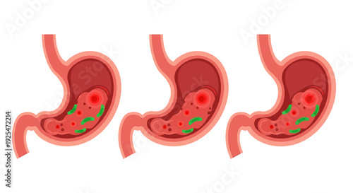 Illustration of a Human Stomach Showing Digestion Process.