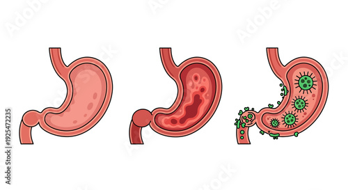 Illustration of Stomach Health Progression from Healthy to Infected.