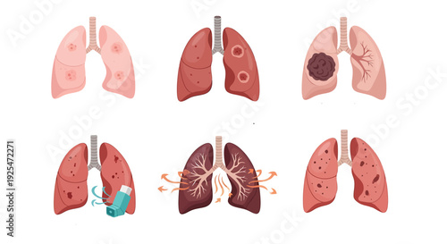 Illustration of various lung conditions and diseases affecting human respiratory system.