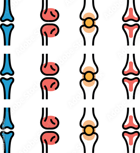 Anatomical illustration of various knee joint conditions and bone structures
