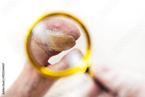 Fotografi doctor examining toenail with onychogryphosis under magnifying glass