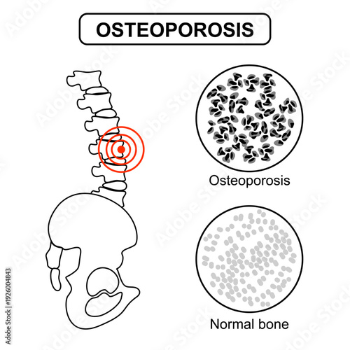 Illustration of osteoporosis and healthy bones. Systemic skeletal disorders, human hip bone, loss of bone mineral density. Risk of fracture. Line Draw illustration for medical, clinic, and education
