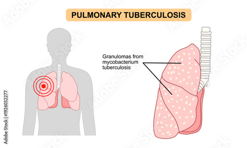 Medical illustration of Tuberculosis (TB) infection in human lungs. granuloma formation, Mycobacterium tuberculosis. Vector illustration for health care, education, respiratory disease.
