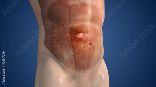 Epigastric Hernia Formation in Upper Abdomen
