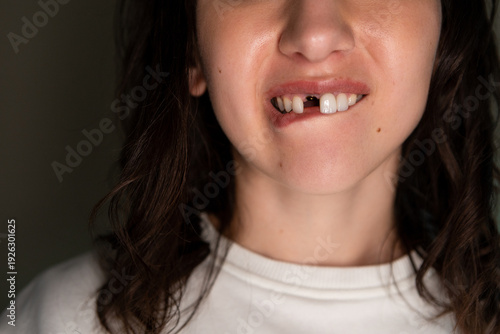 Foto Mature Caucasian brunette woman missing a front tooth.