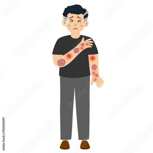 Man suffering from a skin rash. Distressed man from a severe skin rash, allergies, and eczema.