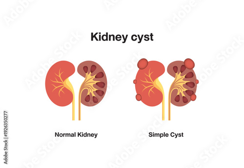 Kidney cysts polycystic urinary disease. Renal cysts of fluid in the kidneys. Medical diagram