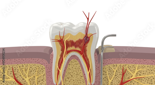 Detailed dental anatomy illustration showing tooth structure, roots, and surrounding gum tissue with dental tool