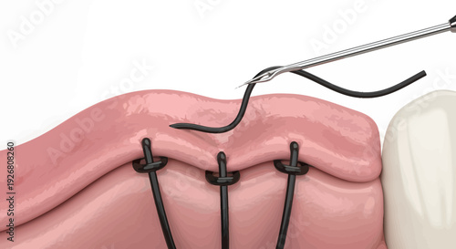 Surgical procedure illustration showing suturing technique on gum tissue with medical instrument