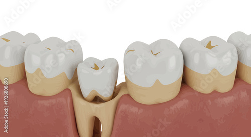 Dental illustration showing teeth and gums with a missing tooth close-up view from the side