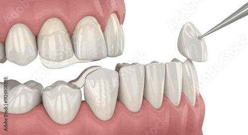 Dental prosthesis being placed on a set of artificial gums and teeth from a close-up viewpoint