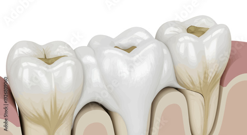 Dental Illustration Showing Healthy and Decayed Teeth in Close-up View