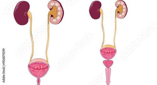 Anatomical comparison of the human urinary system, showcasing both a healthy representation and a diagram depicting a medical condition involving the renal and excretory organs