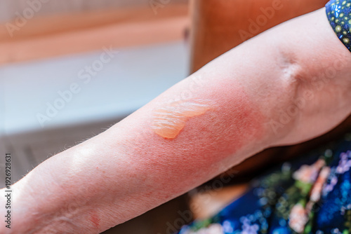 Burned hand with blister and red skin, medical imagery useful for dermatology education