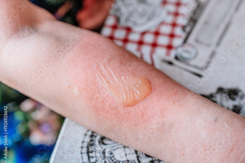 Burned hand with blister and red skin, medical imagery useful for dermatology education