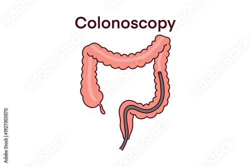 Detailed medical illustration showing the colonoscopy screening process. Using an endoscope to detect polyps and potential cancer within the large intestine for diagnostic purposes.
